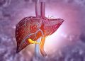 Fibroza în MASLD, legată diferit de riscul cardiovascular
