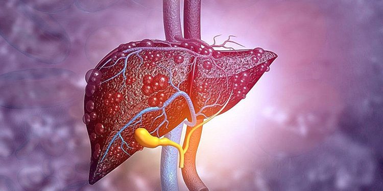 Fibroza în MASLD, legată diferit de riscul cardiovascular